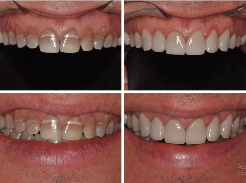 Teeth Preventive Care